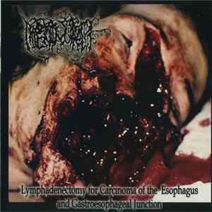 Download Hipermenorrea - Lymphadenectomy For Carcinoma Of The Esophagus And Gastroesophageal Junction